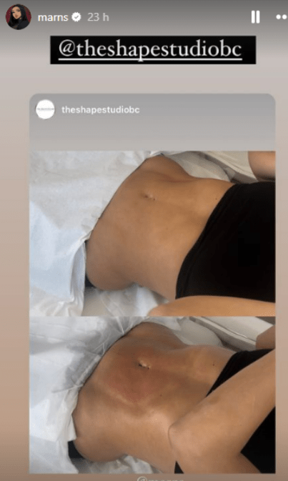 The non-invasive procedure 'melts away' fat