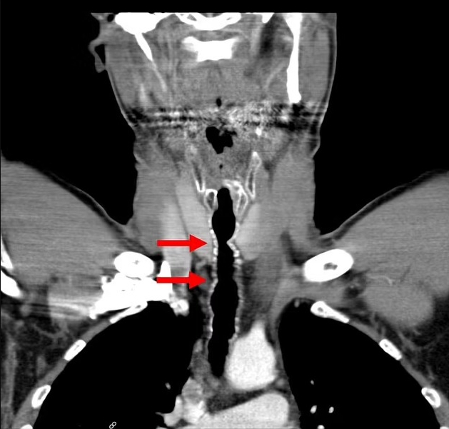 A scan of the man's throat, with the arrows pointing to places where the hairs were found