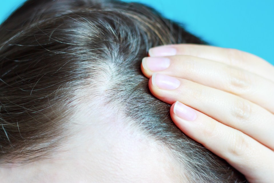 Scientists found that a biological stress response can kill off scalp cells