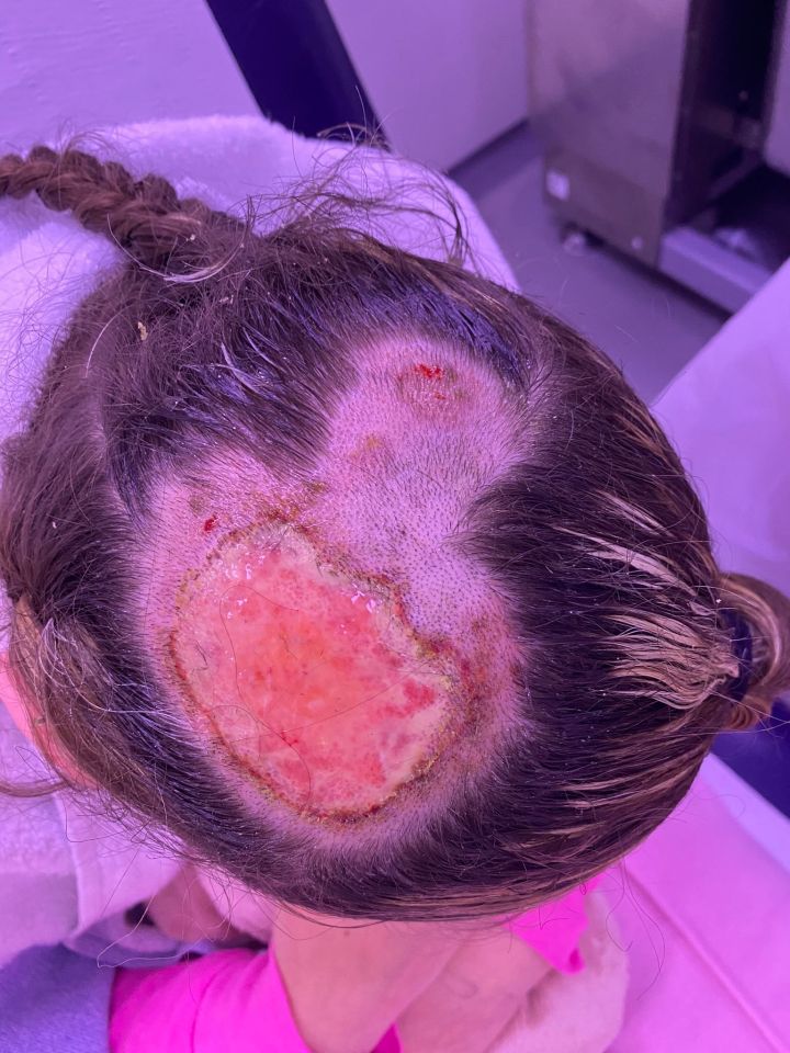 Horrifyingly, despite going to a professional salon they trusted, the teen was left with agonising burns