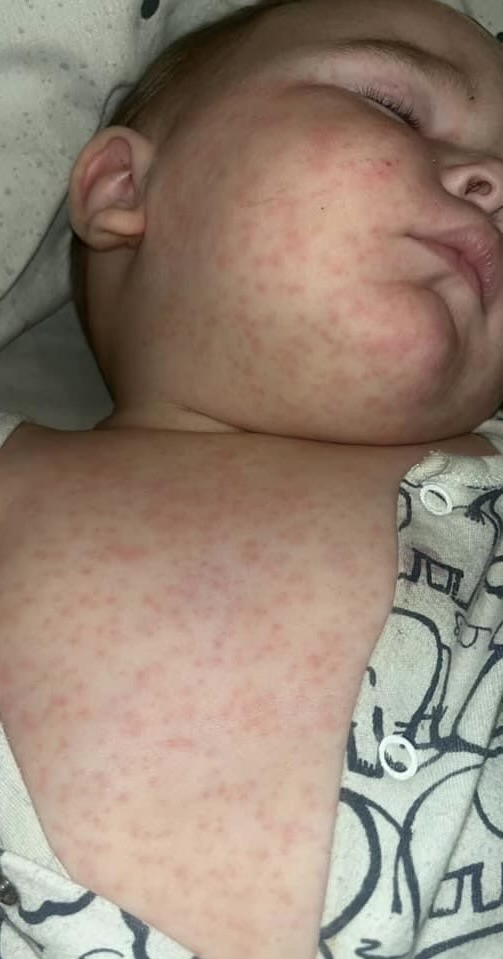 Holly’s baby developed a rash once they returned home Dagenham