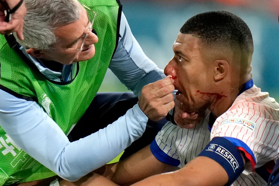 Kylian Mbappe suffered a horror nose injury