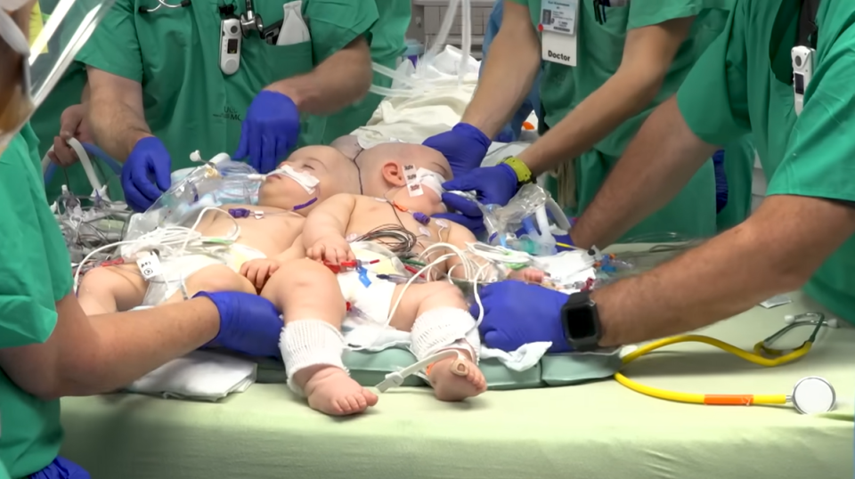 At just nine months of age, the underwent a gruelling 24-hour operation to separate their skulls, brains and circulatory systems