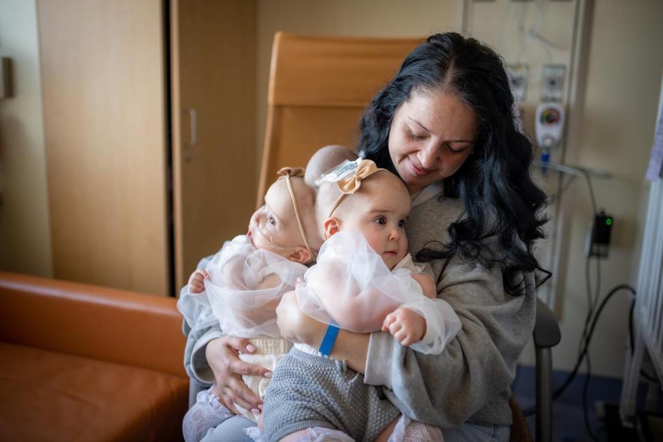 Abigail and Micaela Bachinskiy were born conjoined at the head