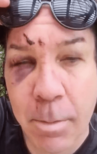 Bobby Reeves revealed his black eye and cuts on his head after a fight with Seth