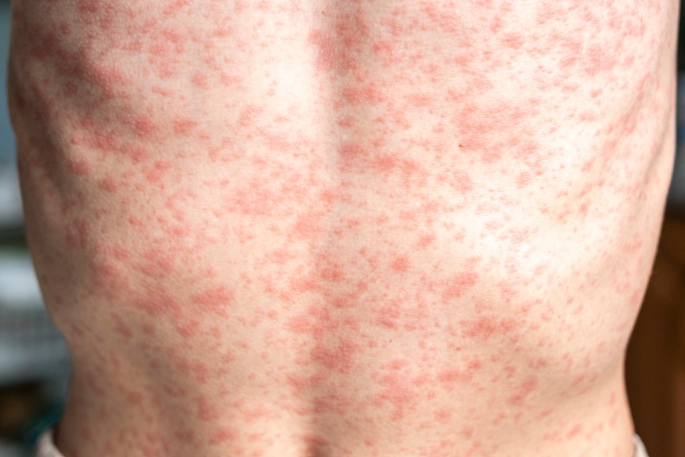 The UK saw a huge surge in measles cases at the end of 2023 and it this year