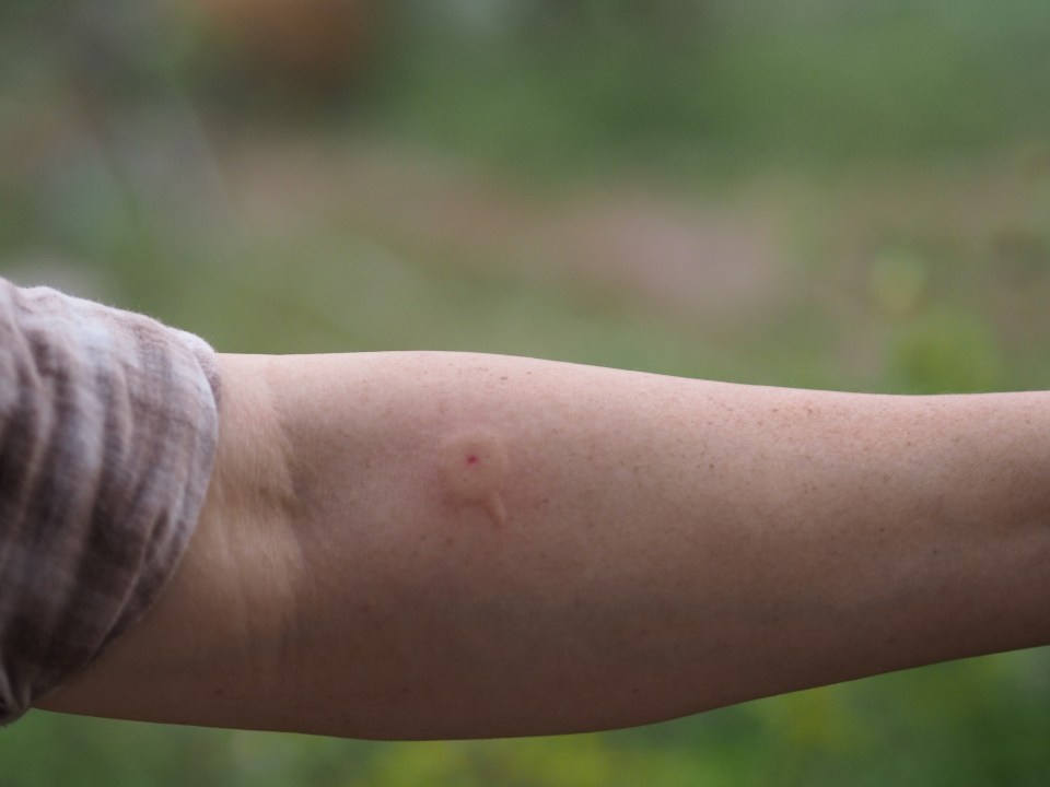 A wasp sting can leave a swollen red mark on your skin