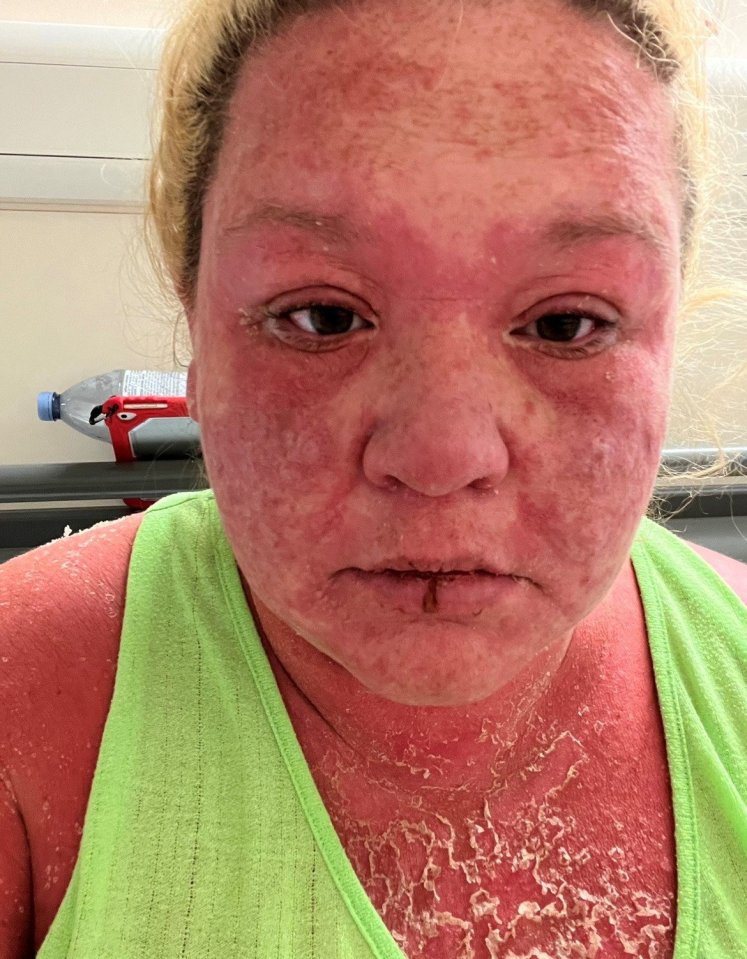 She got a huge rash over her whole body after the bite and was treated with antibiotics