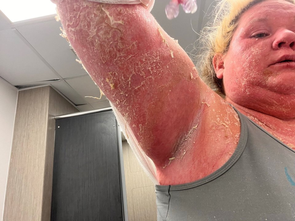 The 37-year-olds skin peeled off after she was bitten by a mosquito