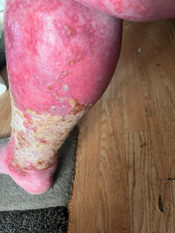 Some skin stuck to her legs leaving open wounds which turned green after she was discharged