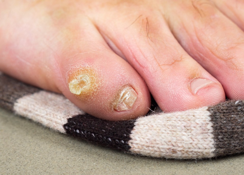 Living in flip-flops or sandals that give little support is usually to blame for corns and calluses