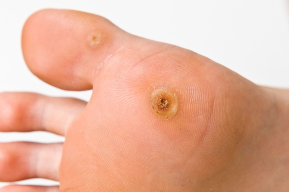 Characterised by a black dot on the skin’s surface, verrucas are brought on by the human papilloma-virus