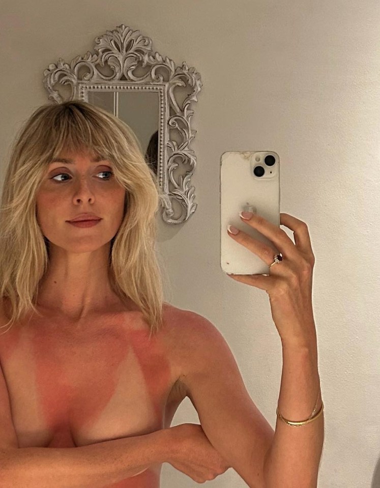 Diana Vickers went topless as she showed off her sunburn on her chest