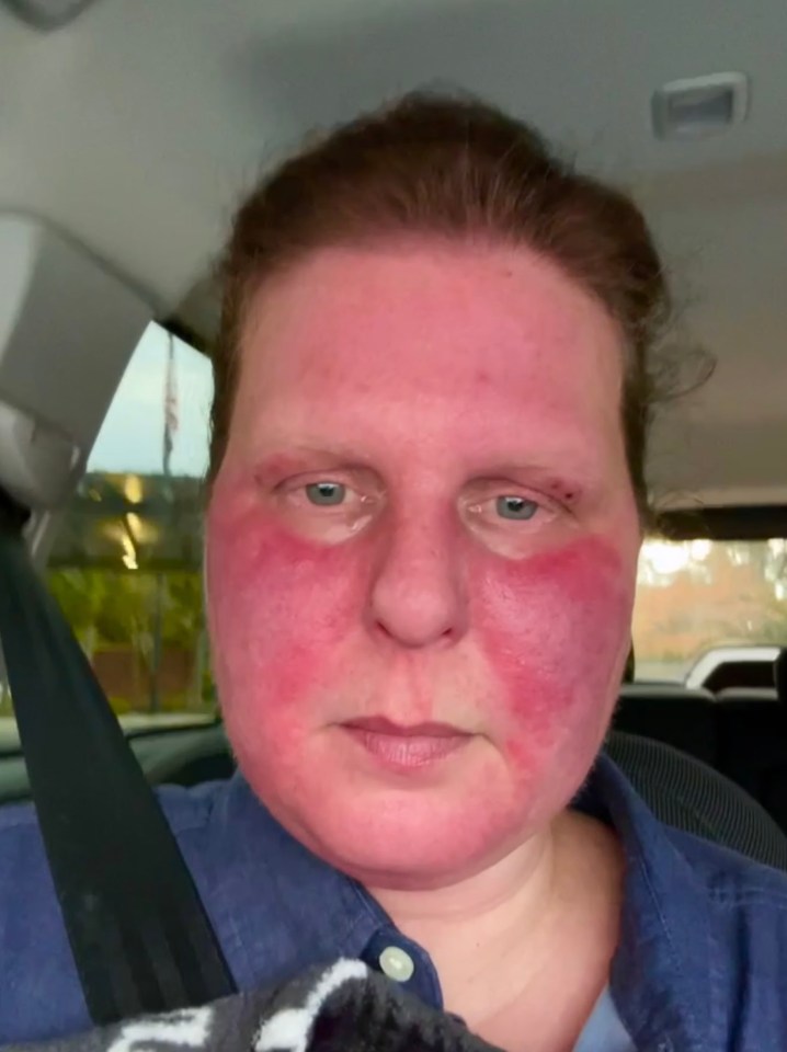 Doctors took a biopsy of Lara’s face and the results concluded that she may have rosacea