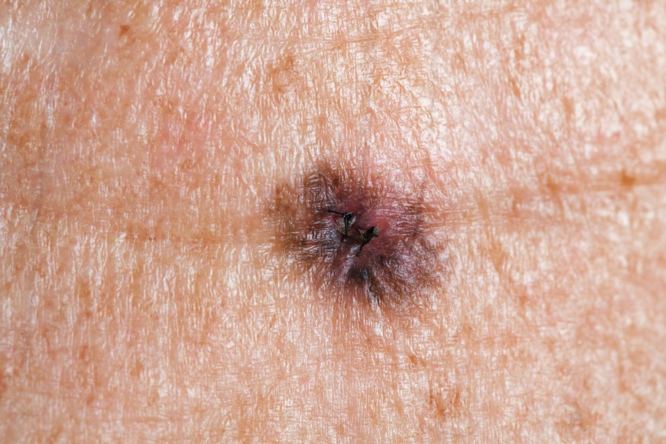 The signs of a melanoma can be remembered using the acronym ABCDE