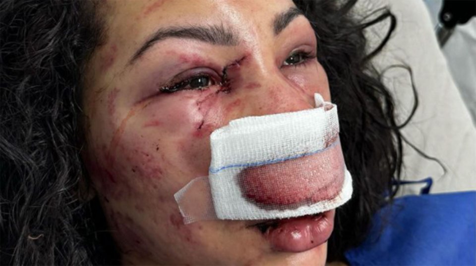 Maressa Nunes, 31, from Brazil, was left unrecognisable with a puffed up face after the violent attack where thugs robbed her and a friend while they holidayed in Chile