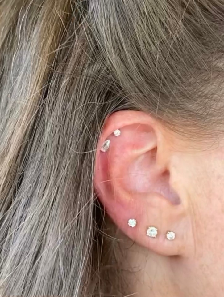 The mum noticed her ear became red, warm to the touch, and swollen in the days after the procedure