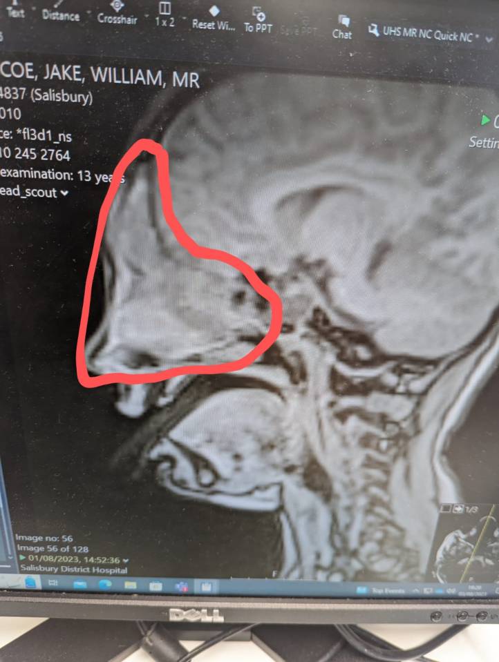 A scan revealed a tumour in his skull