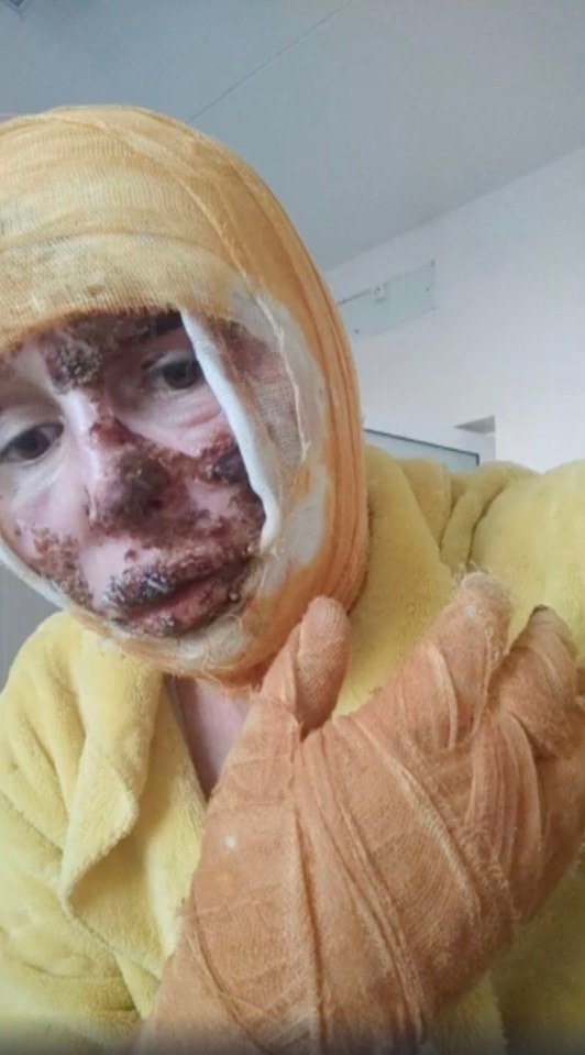 Oksana had severe burns to the upper limbs, upper respiratory tract, neck, face, and buttocks