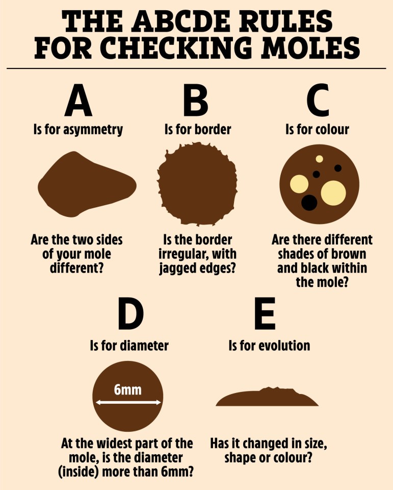 The ABCDE rule for checking moles