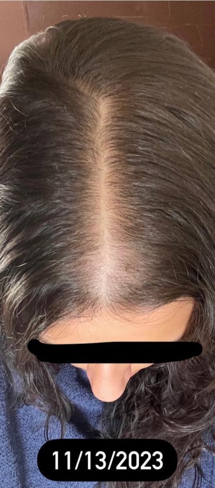 The woman's hair was thin and patchy