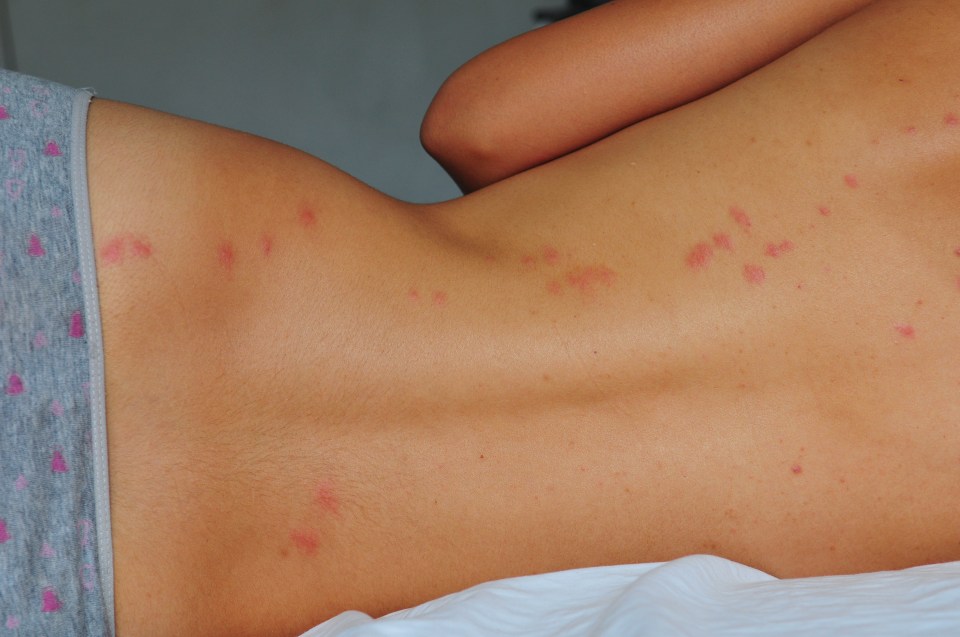 Two-day old lines of bedbug bites on a woman’s back