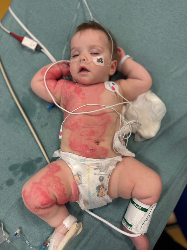 Addison Starnes, now one, with horrific second and third-degree burns which covered 20% of her body.