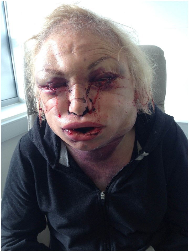 Kellie after one facial feminising operation in 2014