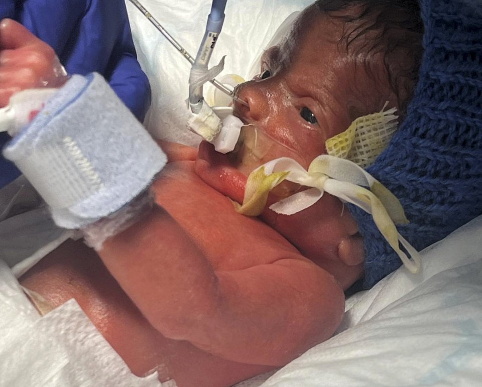 His skin was so delicate, his parents weren't allowed to touch him for 10 days