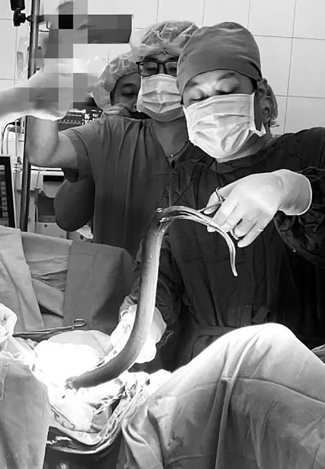 Grim pictures show surgeons pulling the eel from the man's intestines at a hospital in Vietnam