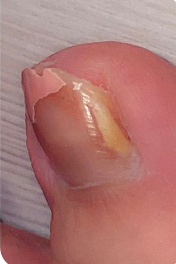 Her nail technician spotted a mark on one of Louise's toenails and urged her to get it checked