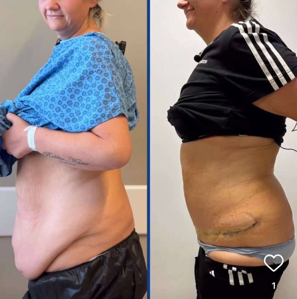 a before and after photo of a woman 's stomach