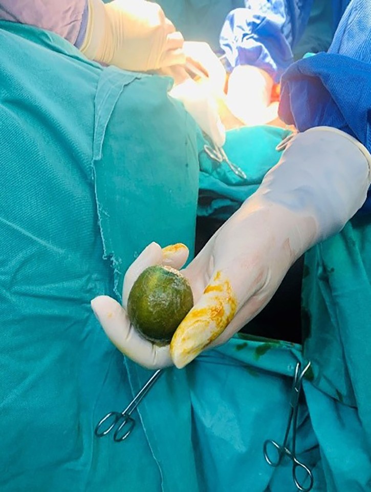 Medics manipulated the lemon back down through the patient's anus until it popped out