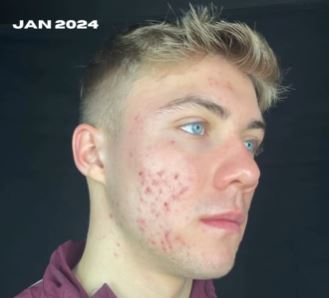 Hojlund had been dealing with an acne problem ever since his arrival at Man Utd