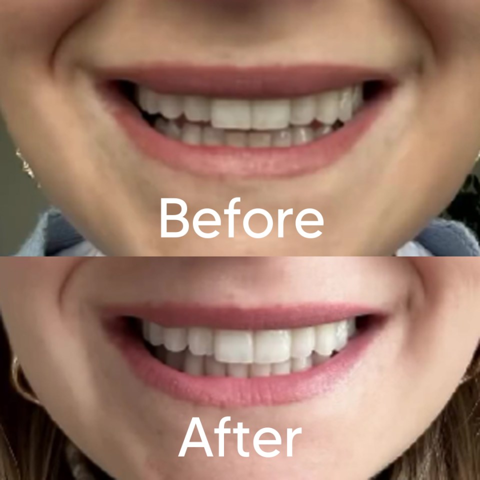 a before and after photo of a woman 's teeth