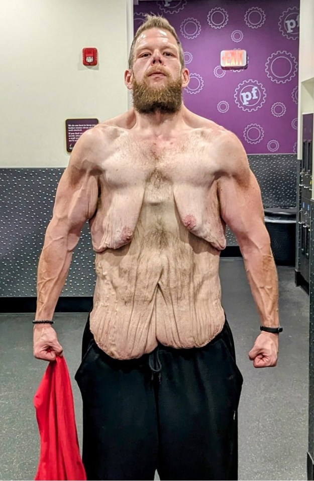 Cole says his lose skin weighs up to a stone