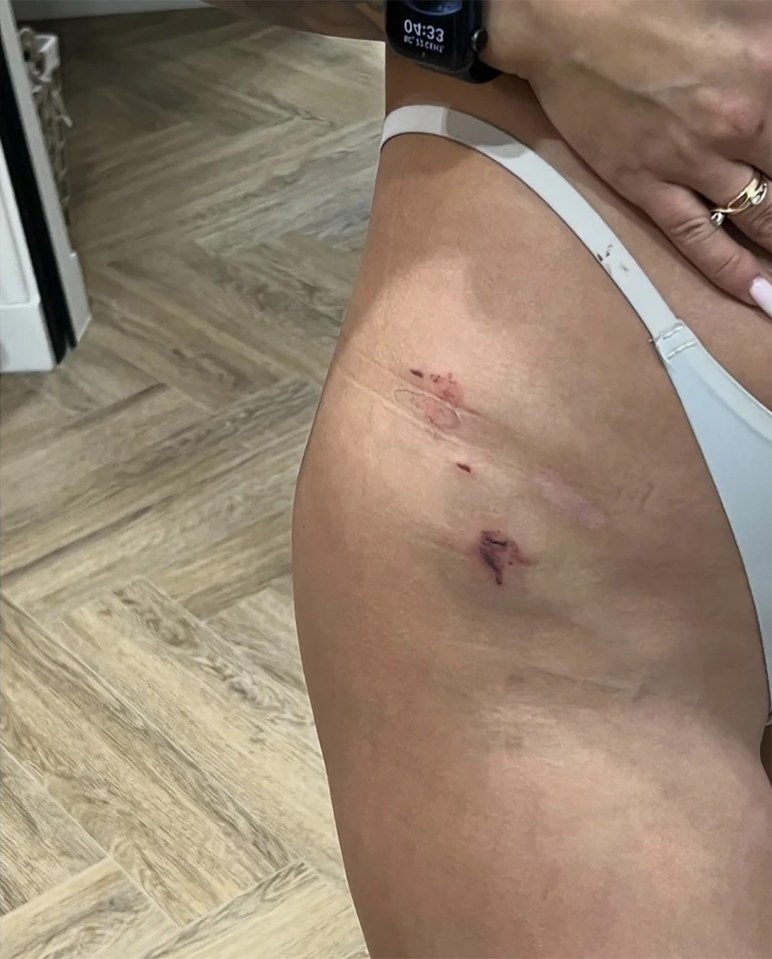 The influencer suffered several bruises and cuts