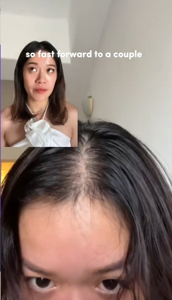 Mabel noticed a bald patch on her scalp