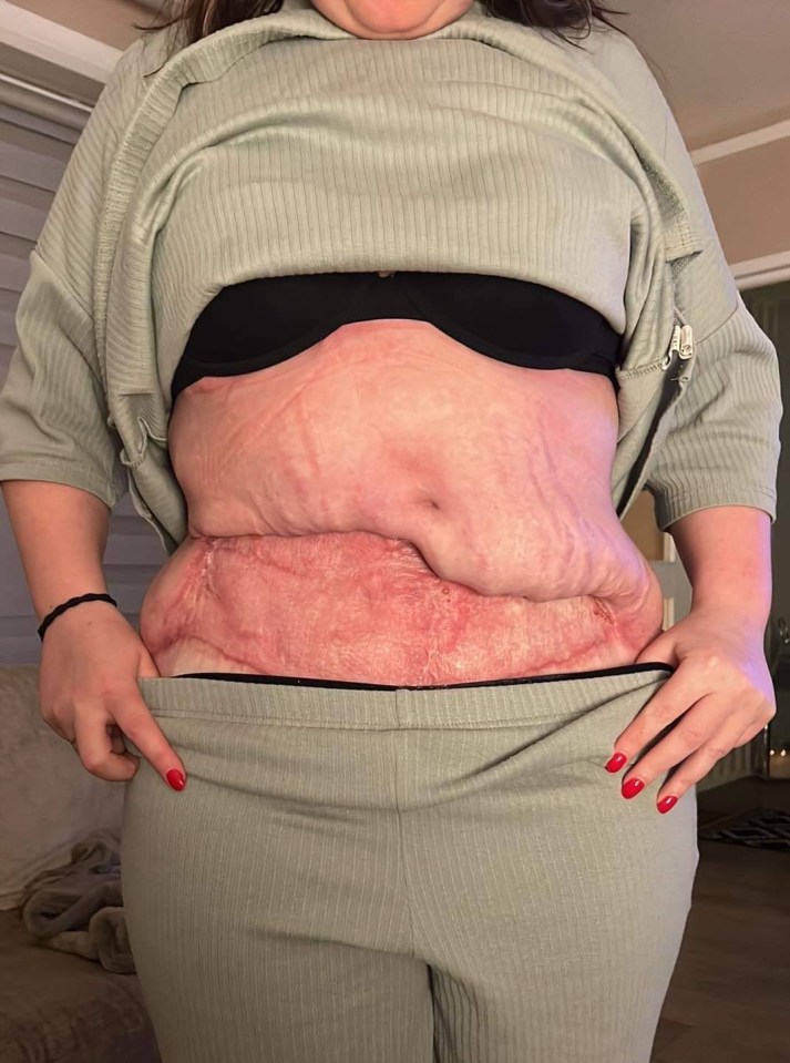 Carrie's stomach now, after the botched surgery, infection and skin graft