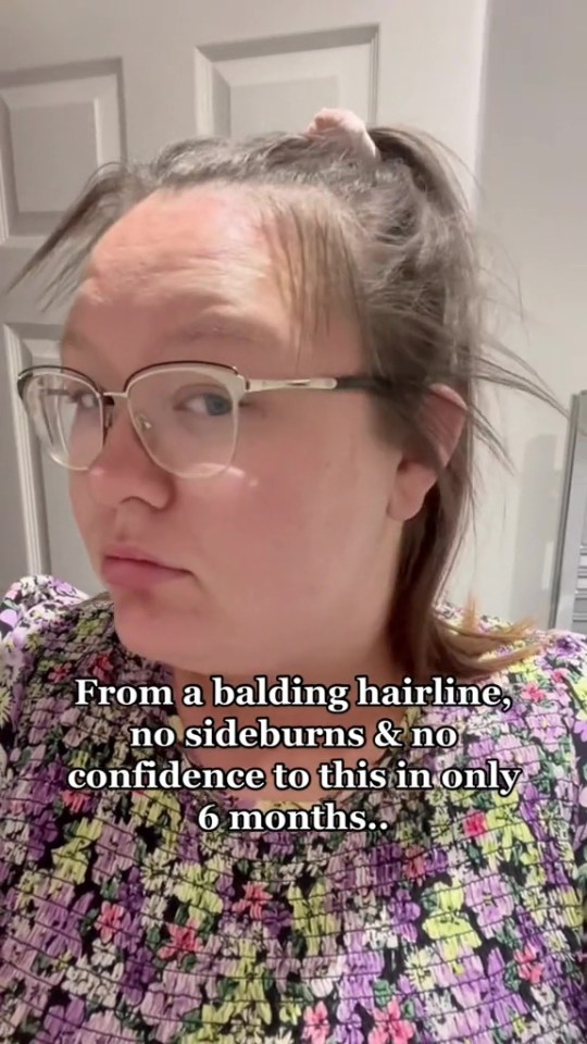 a woman with glasses and a balding hairline has no sideburns and no confidence to this in only 6 months .