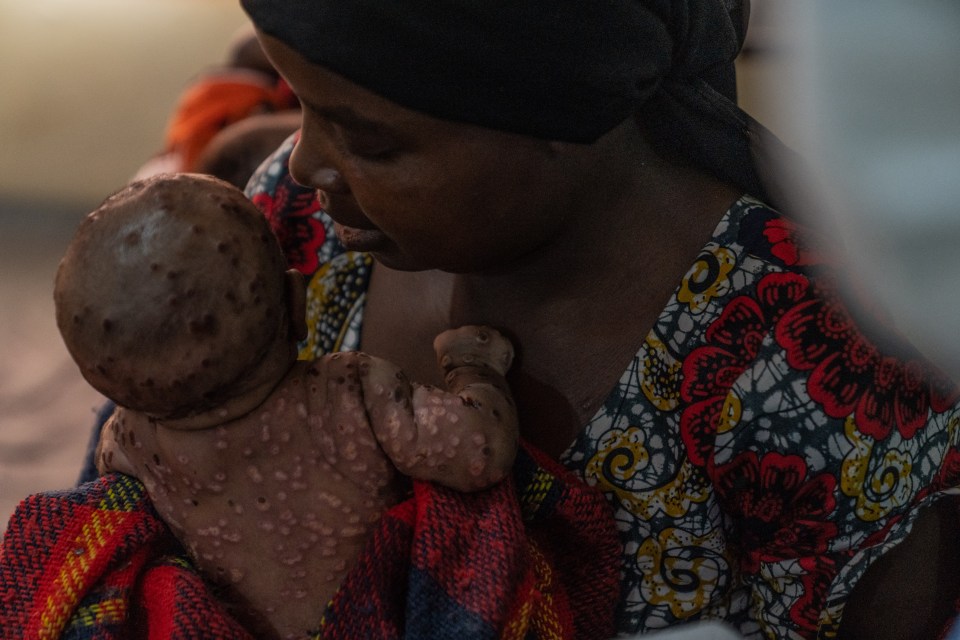 A woman dries her baby suffering from a severe form of mpox at the Kavumu hospital, in eastern Democratic Republic of Congo