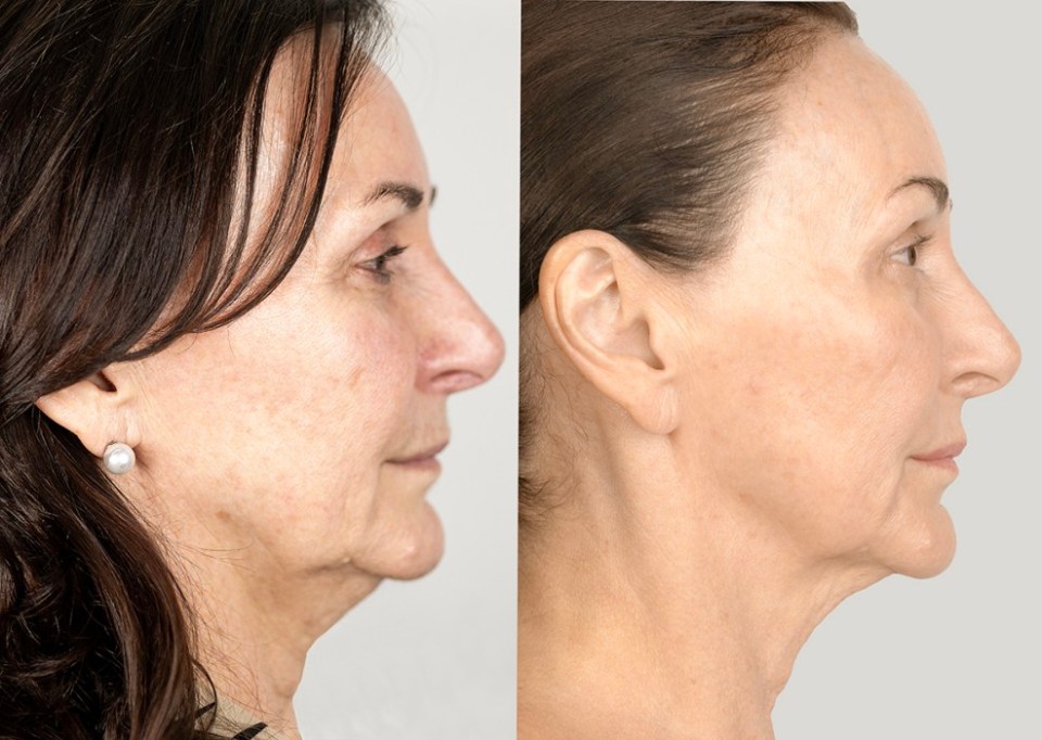 She recently underwent a non-surgical facelift