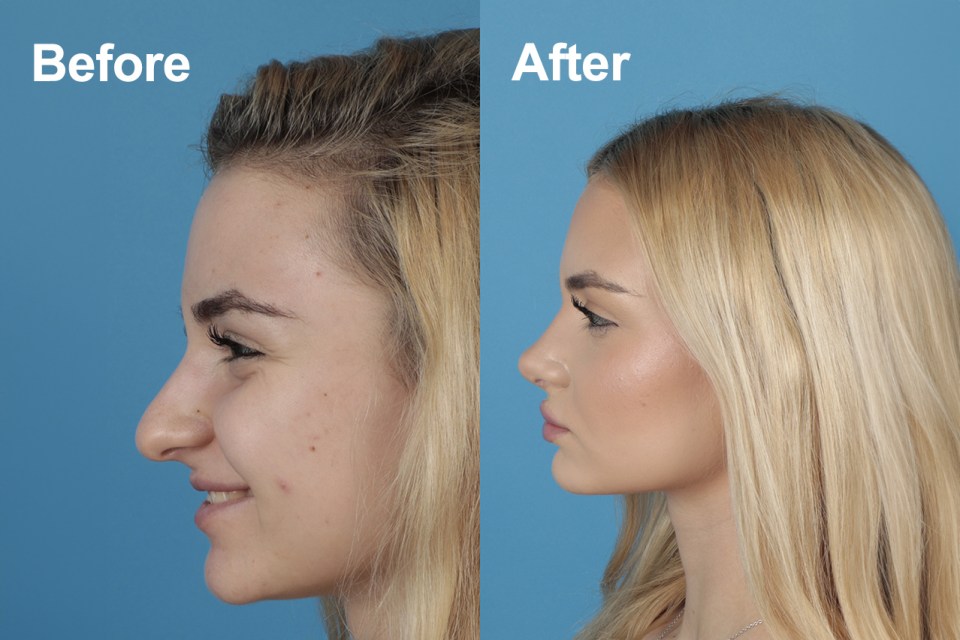 Achieve your dream nose