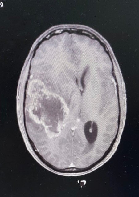 Adam Chapman's brain scan. Photo released September 2024. A father from Worcestershire with an incurable brain tumour is calling for more government funding into research into the disease.Forty-three-year-old Adam Chapman, from Worcester, was running his own business, training in the gym up to five days a week, and competing in 10k assault course races before his glioblastoma (GBM) diagnosis. Adam first started suffering from headaches six months after his wedding day in December 2022 and was rushed to hospital in February the following year..