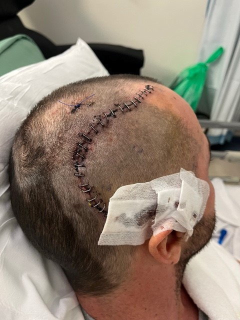 Adam Chapman's surgery scar. Photo released September 2024. A father from Worcestershire with an incurable brain tumour is calling for more government funding into research into the disease.Forty-three-year-old Adam Chapman, from Worcester, was running his own business, training in the gym up to five days a week, and competing in 10k assault course races before his glioblastoma (GBM) diagnosis. Adam first started suffering from headaches six months after his wedding day in December 2022 and was rushed to hospital in February the following year..