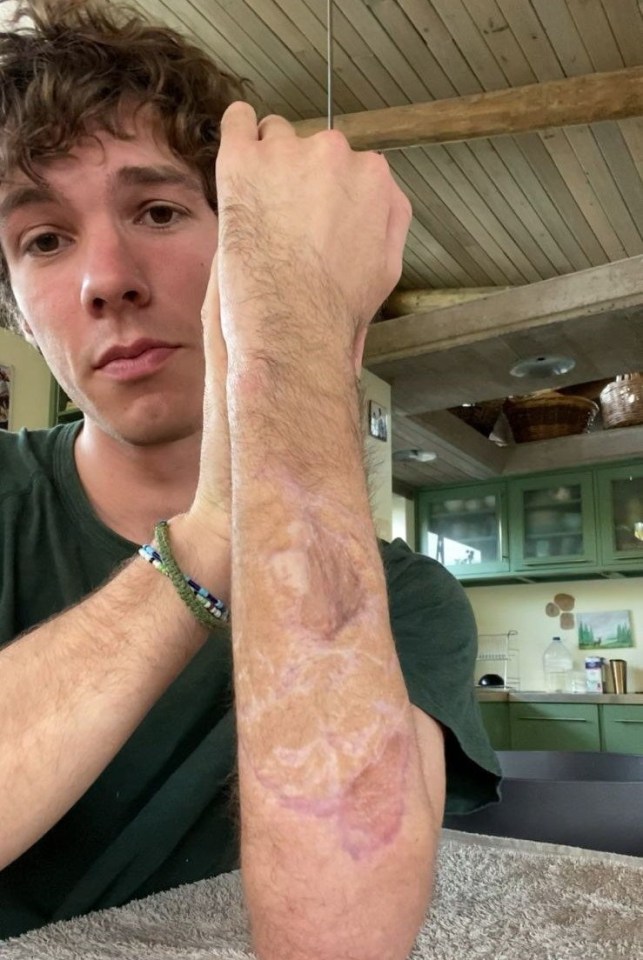 His arm has healed but the big scars remain