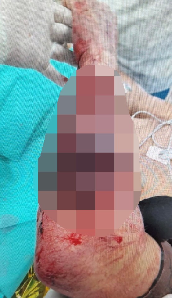 His arm, too graphic to show in full, was left in horror shape