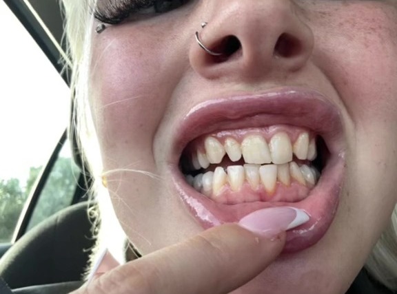 Keisha-Louise also showed off her pre-done teeth in another TikTok