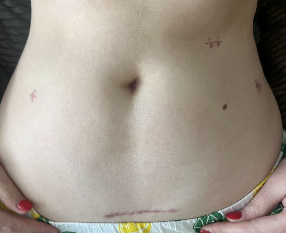 Caitlin's scars following the operation to remove her tumour