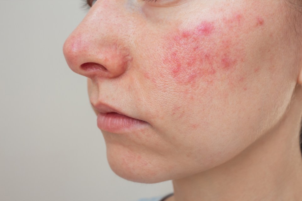 Season change can cause dry and irritated skin, worsening conditions like eczema